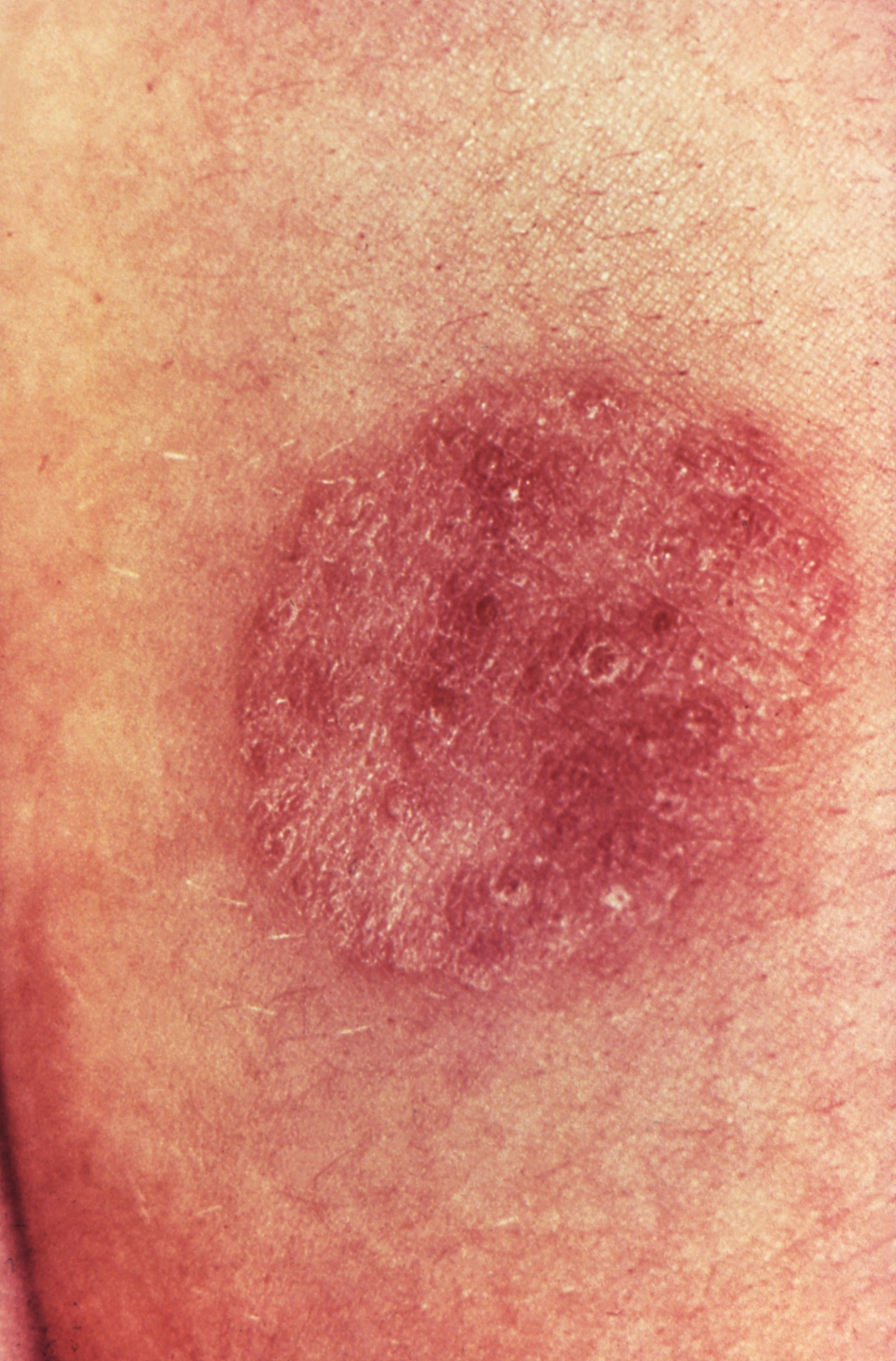 Fungal Infection Image & Photo (Free Trial)